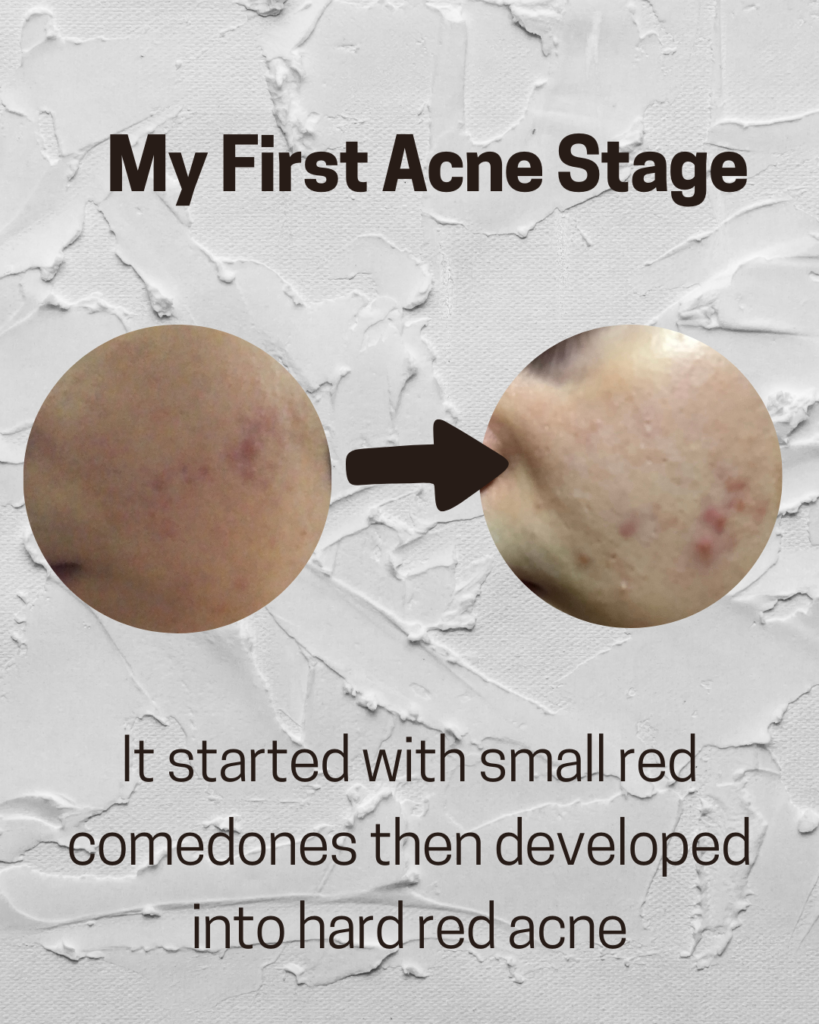 Acne started with small red comedones then developed into hard red acne