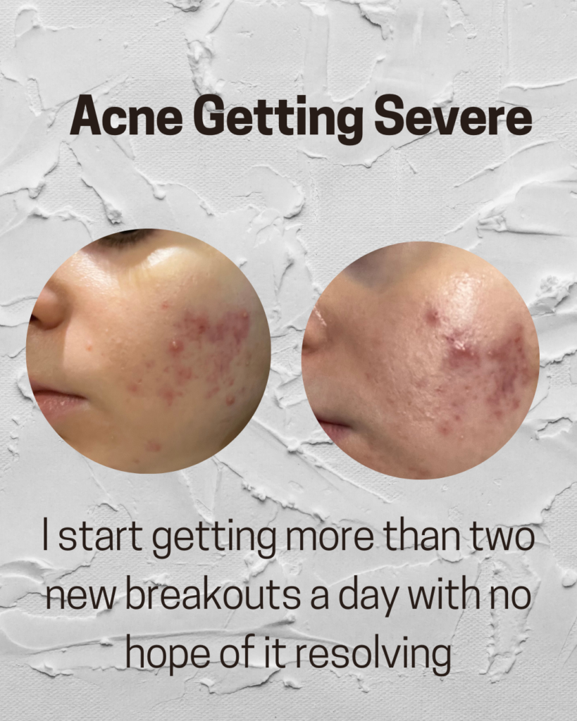 Acne getting severe, I start getting more than two new breakouts a day with no hope of it resolving.